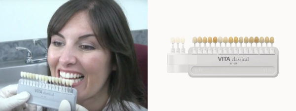Bruxzir Crowns - Order Crowns From Our Dental Lab | Stomadent Dental Lab