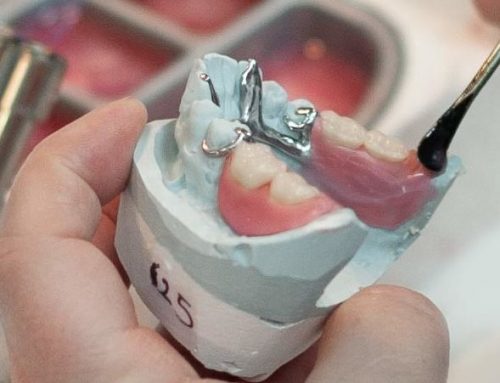 Hybrid Cast/Flexible Partial Dentures: Taking Partials a Step Further