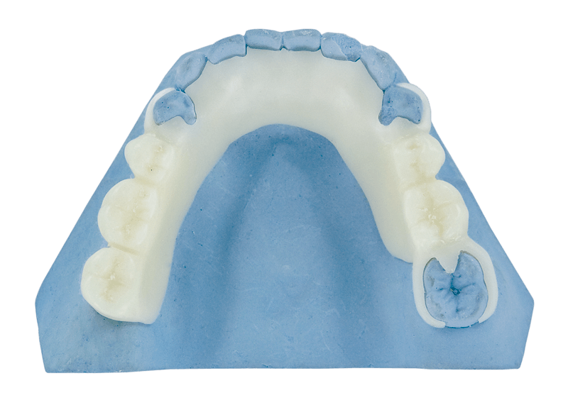 Zirlux Acetal Resin Flexible Partial Dentures