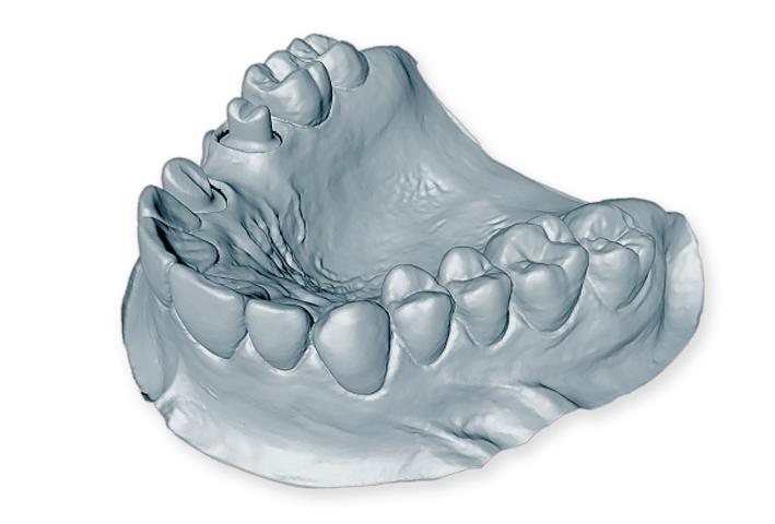 Can you use an intraoral scanner for upper jaw impressions