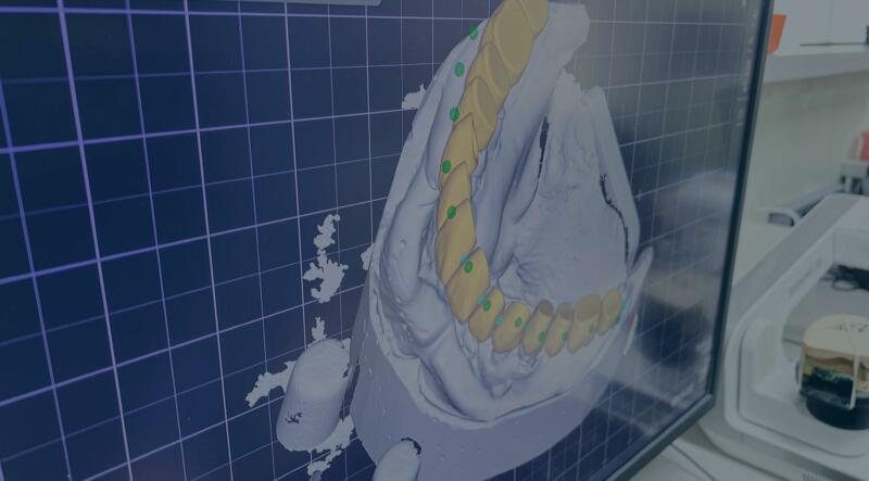3D Laser Printed Metal RPD - STOMADENT