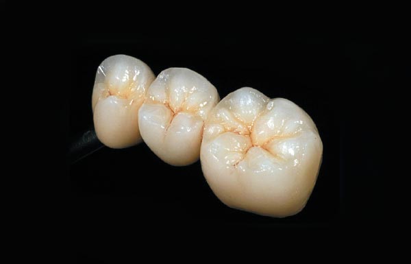 Zirconia Bridge