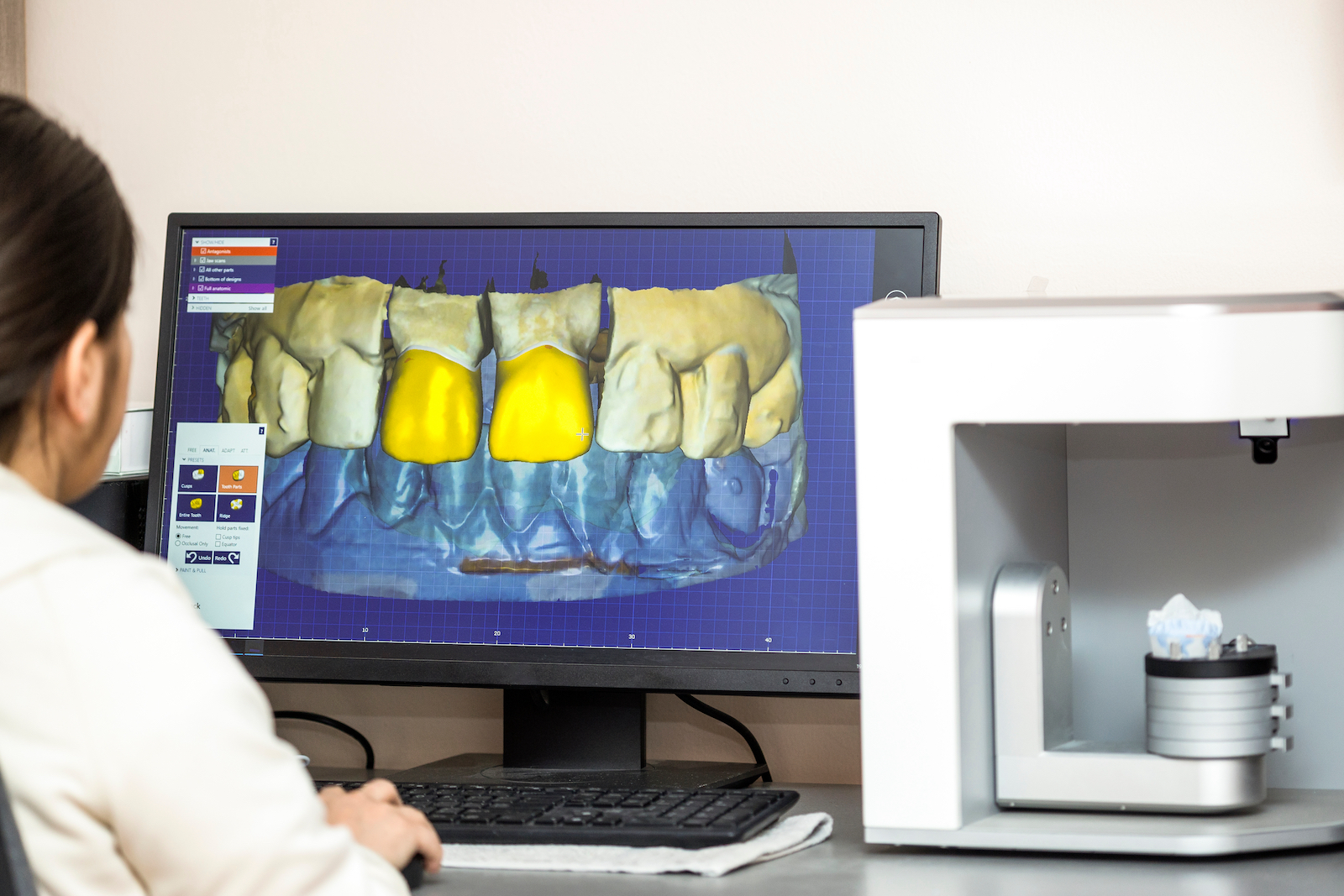 How 3D Printed Dentures Are Made