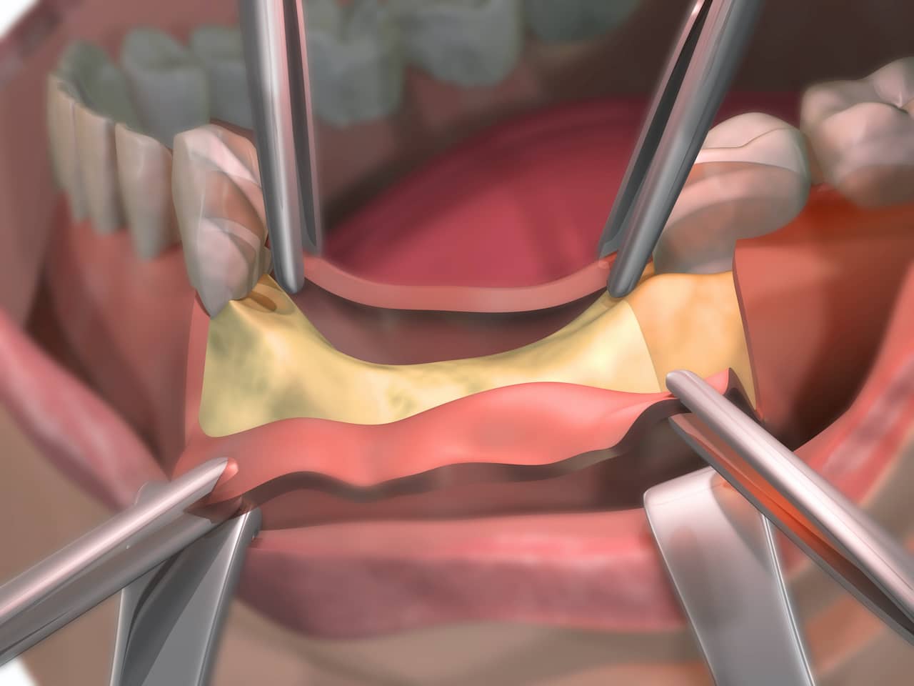 bone grafting materials