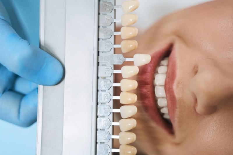 Emax vs. Zirconia Veneers Selecting for Best Patient STOMADENT