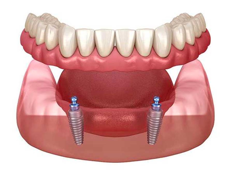 ball-retained snap-on denture bridge