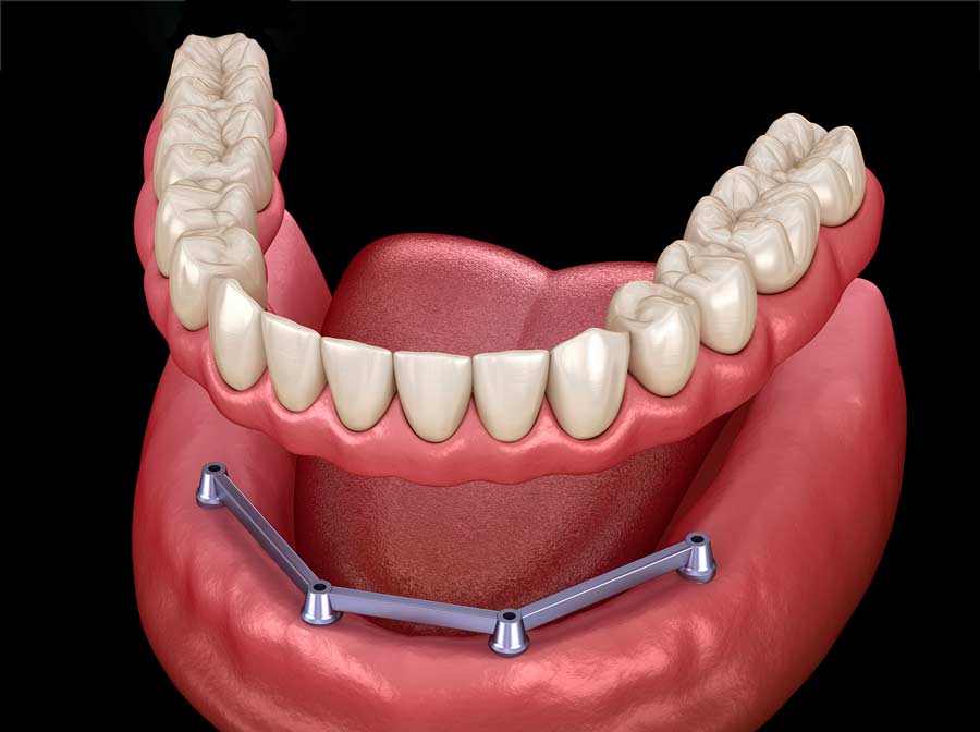 bar-retained snap-on denture bridge