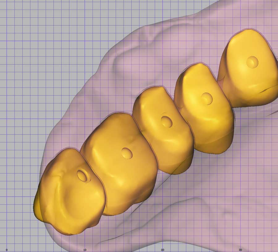 Mechanical bonding of zirconia teeth and PMMA multi-layered acrylic