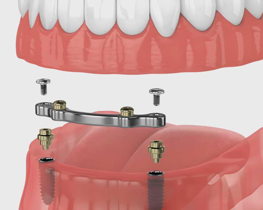Different implant systems
