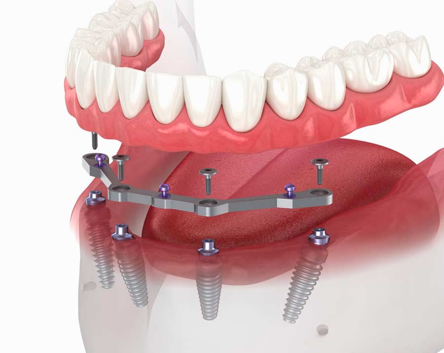 Titanium Bar perfect fit