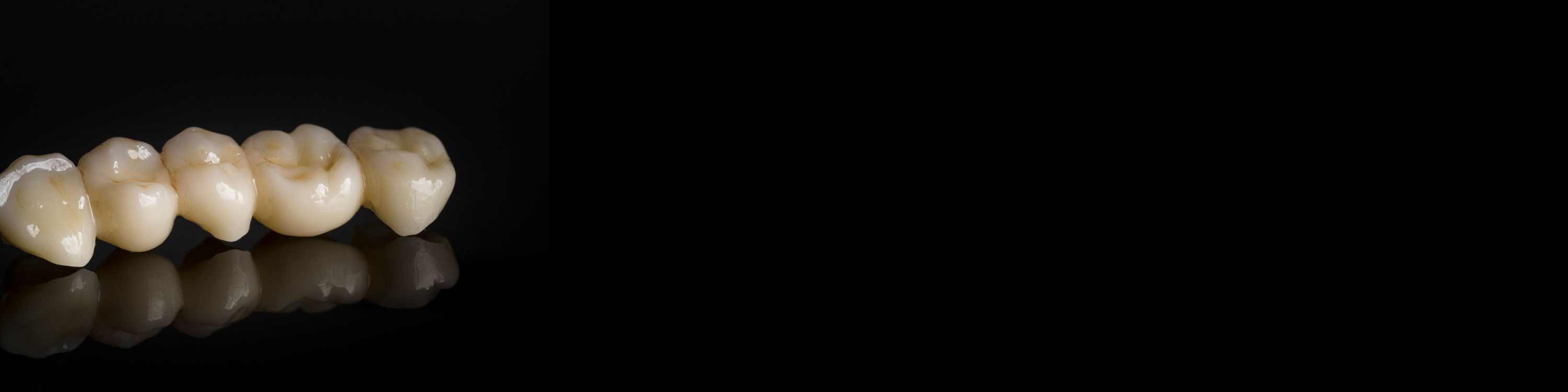 zirconia bridge